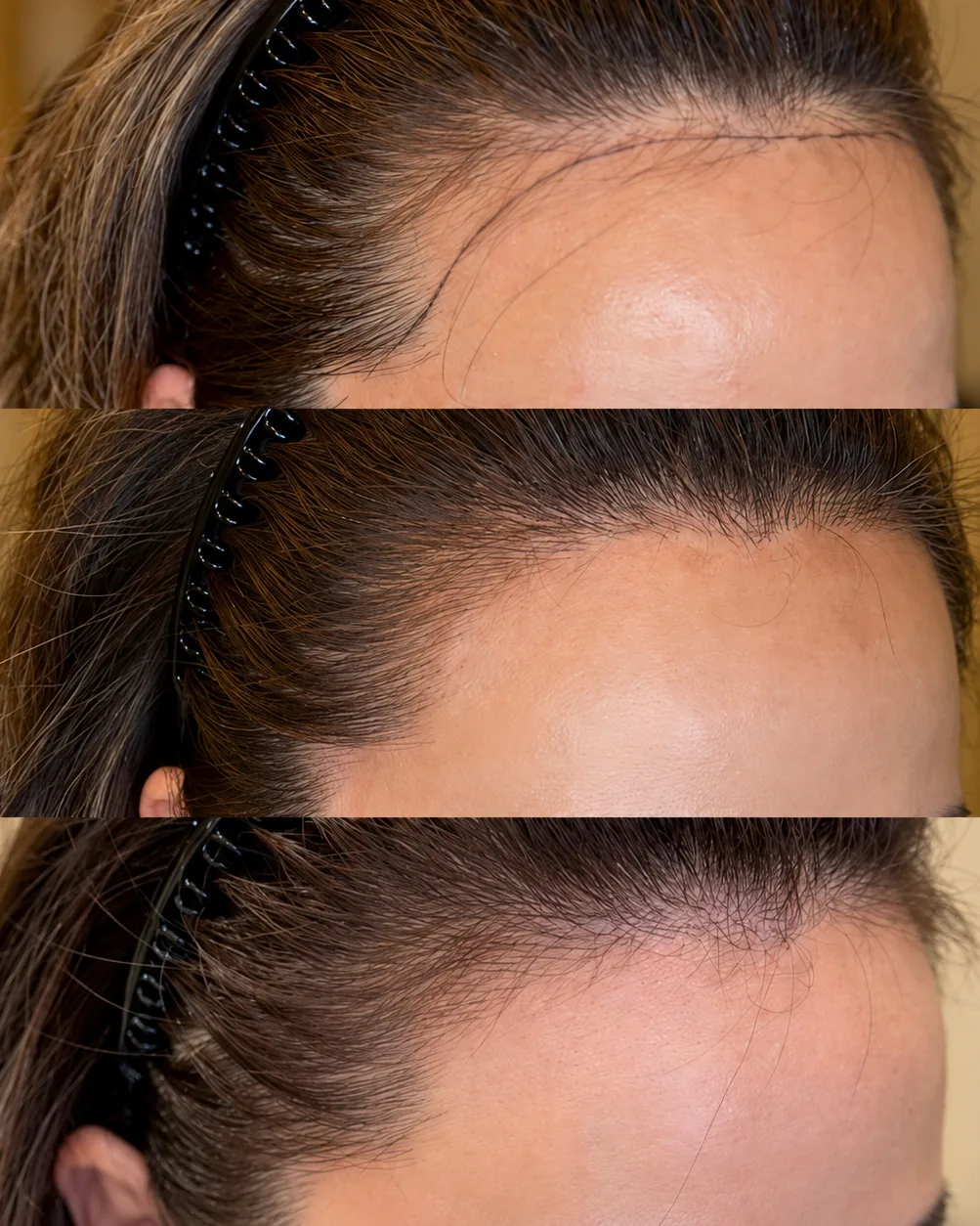 Three views of a woman's front hairline wearing a headband: top, the new hairline drawn on the forehead as a design; middle and bottom, the hairline filled in with hair strokes